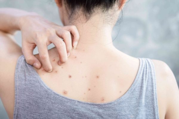 Bacne Treatment