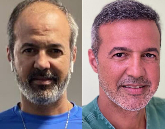 FUE Method: A Modern Solution to Hair Loss